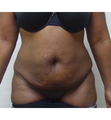 tummy tuck black skin